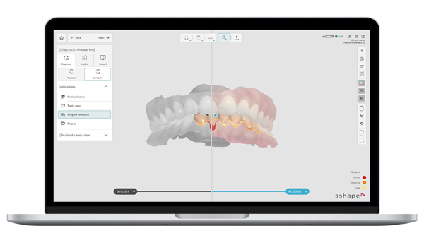 TRIOS 6 AI 진단 화면 (사진 출처: 3Shape Partner Portal)